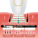 Depilador Laser IPL